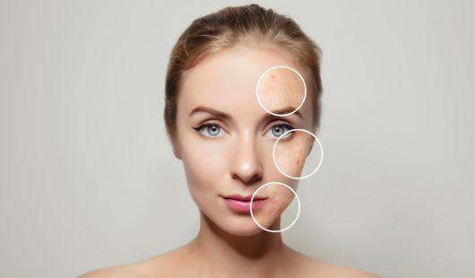 Acné et Peau Réactive  Quelle Taie d’Oreiller Choisir 
