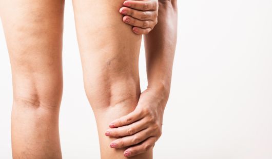 jambes lourdes 